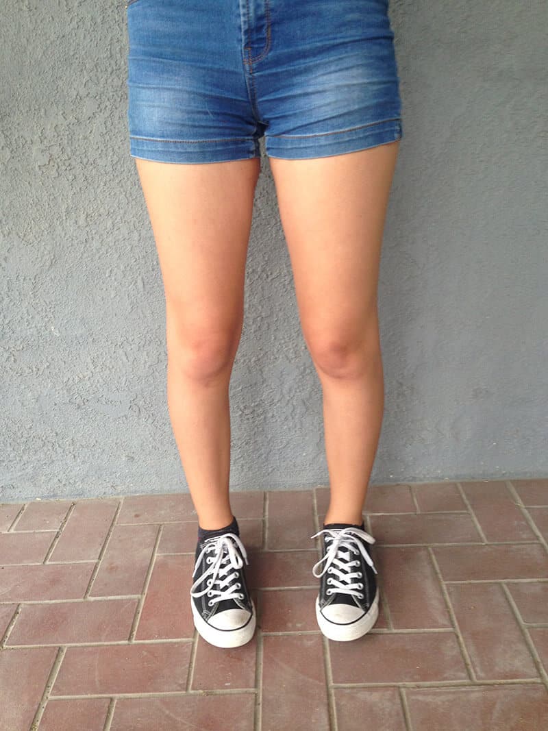 Knock-Kneed Example When the knee is inside of this line (knock kneed), there will be compression to the outer knee and distraction to the inner knee.